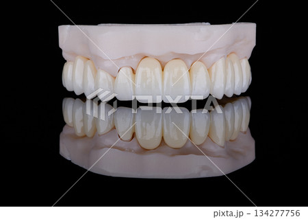 High-quality full-arch dental bridge made of zirconium for fixation to upper jaw. High-quality full-arch dental bridge made of zirconium for fixation to upper jaw. 134277756