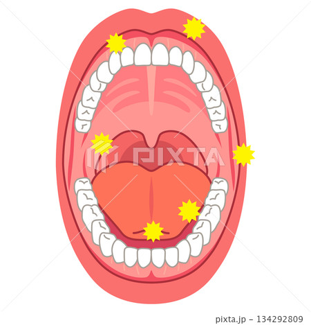 口内炎の出来やすい場所　口の中　医療 134292809