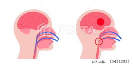 Obstructive sleep apnea Obstructive sleep apnea 134312925