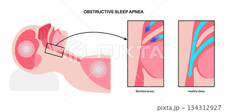 Obstructive sleep apnea 134312927
