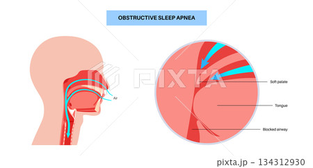 Obstructive sleep apnea 134312930
