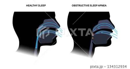 Obstructive sleep apnea 134312934