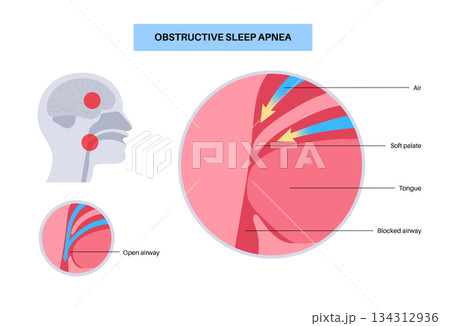 Obstructive sleep apnea 134312936