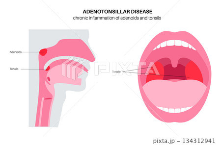 Adenotonsillar disease poster 134312941