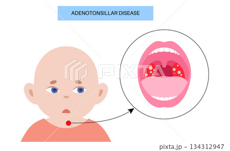 Adenotonsillar disease poster Adenotonsillar disease poster 134312947