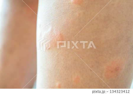 Young asian man has allergic skin rash on his legs from itchy dry skin eczema dermatitis insect bites Young asian man has allergic skin rash on his legs from itchy dry skin eczema dermatitis insect bites 134323412