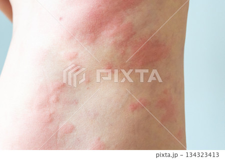 Young asian man itching and scratching on his back from allergic itchy dry skin eczema dermatitis insect bites Young asian man itching and scratching on his back from allergic itchy dry skin eczema dermatitis insect bites 134323413