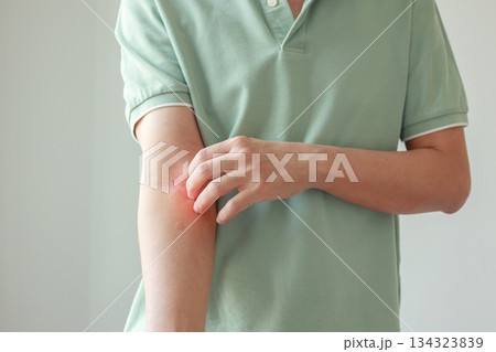 Young asian man itching and scratching on arm from allergic itchy dry skin eczema dermatitis insect bites Young asian man itching and scratching on arm from allergic itchy dry skin eczema dermatitis insect bites 134323839