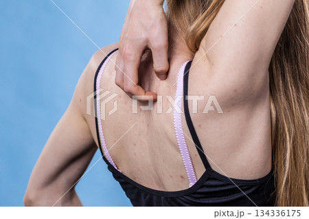 Woman with skin problem acne on back 134336175