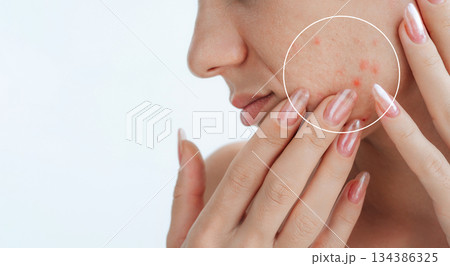 close-up female face with pimples and acne on white isolated background. Woman with problematic skin. Collage of problem skin before and after treatment and care. Clean healthy and bad unhealthy skin 134386325