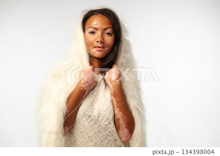 Young African woman with vitiligo wearing elegant 134398004
