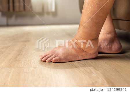 Elderly woman has edema or swelling foot. 134399342