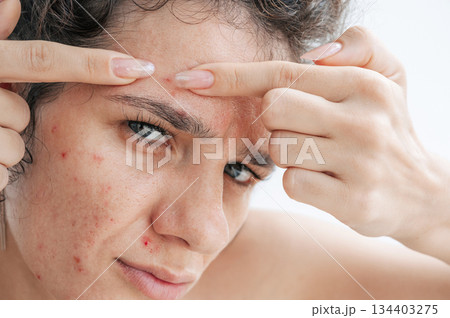close-up portrait of woman face with pimples and acne. A young girl squeezes out inflamed red pimples on the skin of face with fingers on a white background close-up portrait of woman face with pimples and acne. A young girl squeezes out inflamed red pimples on the skin of face with fingers on a white background 134403275