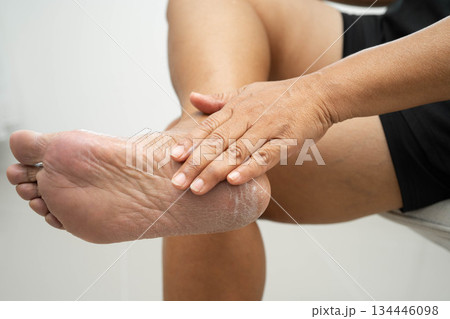 Asian woman check feet with crack and dry heel skin, Diabetic Foot. 134446098