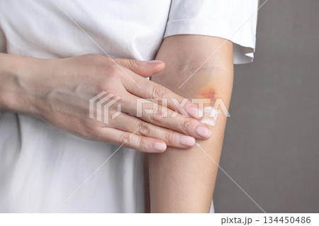 Woman hurt her hand. There is a bruise on the arm. A woman smears a hand with ointment from bruises. Anti-bruising cream, anti-inflammatory cream, pain cream. Cropped photo, close up 134450486