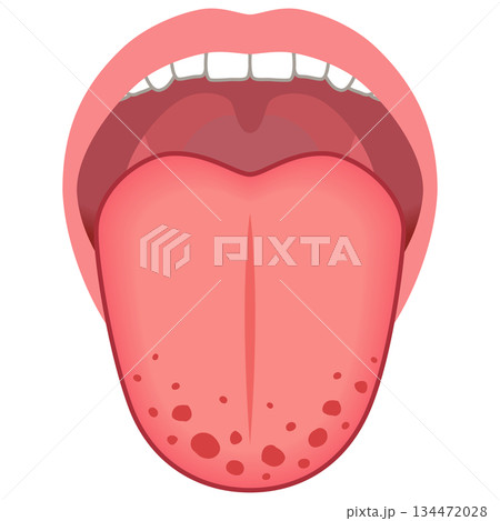 いちご舌 紅点 舌でわかる健康状態 舌診 舌の健康 いちご舌 紅点 舌でわかる健康状態 舌診 舌の健康 134472028