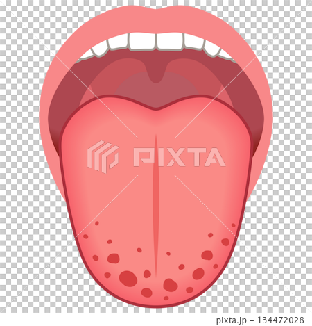 いちご舌 紅点 舌でわかる健康状態 舌診 舌の健康 いちご舌 紅点 舌でわかる健康状態 舌診 舌の健康 134472028