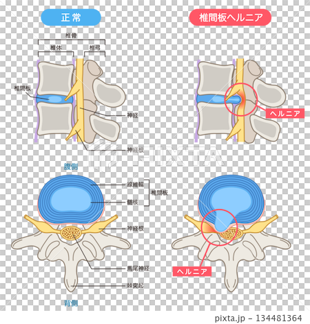 腰椎間盤突出結構 腰椎間盤突出結構 134481364