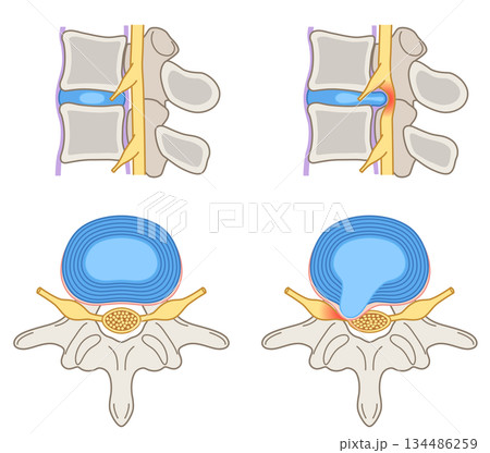 腰椎椎間板ヘルニア 椎間板の構造 腰痛 腰椎椎間板ヘルニア 椎間板の構造 腰痛 134486259