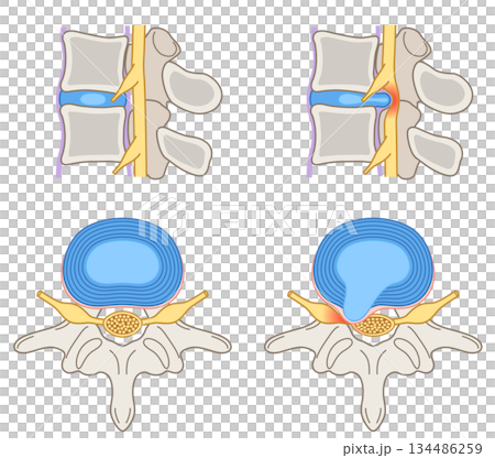 腰椎椎間板ヘルニア 椎間板の構造 腰痛 腰椎椎間板ヘルニア 椎間板の構造 腰痛 134486259