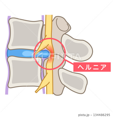 腰椎椎間板ヘルニア　椎間板の構造　腰痛 134486295