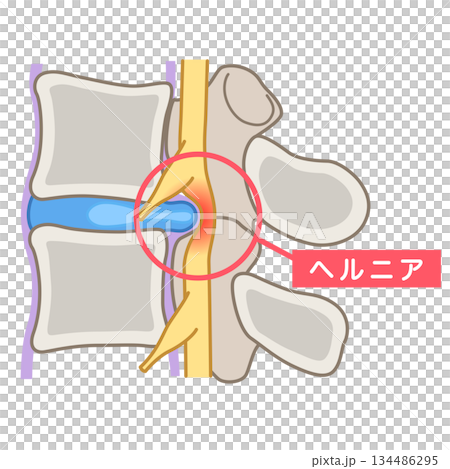 腰椎椎間板ヘルニア　椎間板の構造　腰痛 134486295