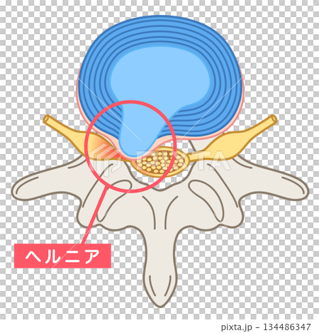 Lumbar disc herniation, structure of the intervertebral disc, lower back pain Lumbar disc herniation, structure of the intervertebral disc, lower back pain 134486347