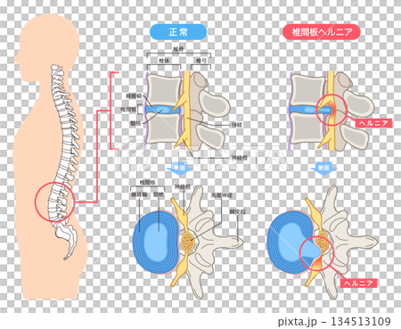 Lumbar disc herniation, structure of the intervertebral disc, lower back pain Lumbar disc herniation, structure of the intervertebral disc, lower back pain 134513109