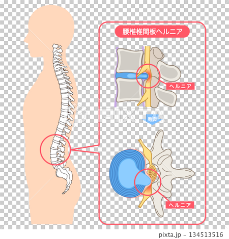 腰椎間盤突出、椎間盤結構、下背痛 腰椎間盤突出、椎間盤結構、下背痛 134513516