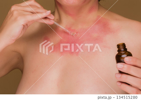 Applying serum to skin rash and allergy condition Applying serum to skin rash and allergy condition 134515280