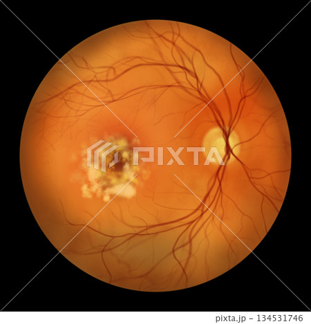 Best disease stage 4, illustration 134531746