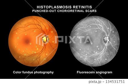 Punched-out chorioretinal scars in ocular histoplasmosis, illustration 134531751