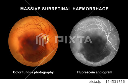 Massive subretinal hemorrhage, illustration Massive subretinal hemorrhage, illustration 134531756