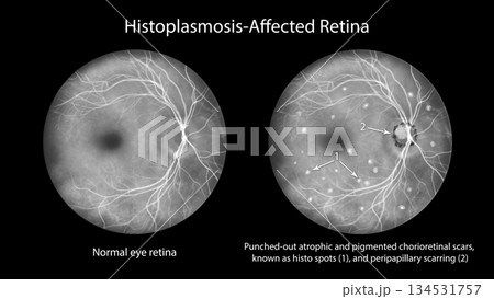 Punched-out chorioretinal scars in ocular histoplasmosis, illustration Punched-out chorioretinal scars in ocular histoplasmosis, illustration 134531757