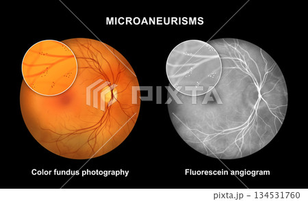 Retina with microaneurysms, illustration Retina with microaneurysms, illustration 134531760