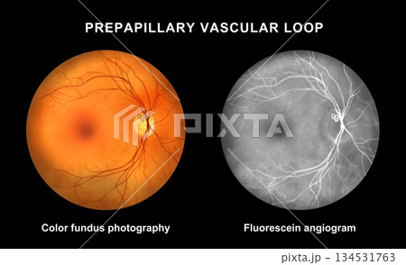 Prepapillary vascular loop, illustration 134531763