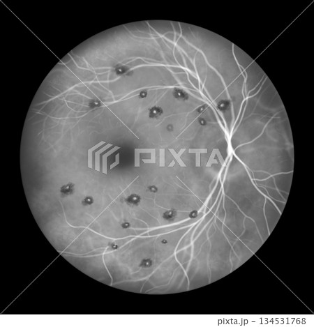 Roth spots, illustration Roth spots, illustration 134531768