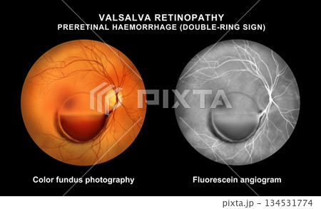 Valsalva retinopathy, illustration 134531774