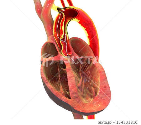Ascending aortic dissection, 3D illustration 134531810