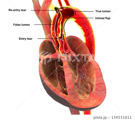 Ascending aortic dissection, 3D illustration 134531811