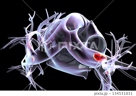 Small segmental or subsegmental pulmonary embolism, 3D illustration. Small segmental or subsegmental pulmonary embolism, 3D illustration. 134531831
