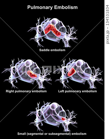 Pulmonary embolism types, 3D illustration. Pulmonary embolism types, 3D illustration. 134531834