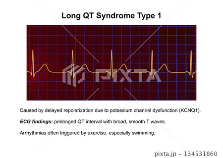 ECG in long QT syndrome type 1, 3D illustration, annotated 134531860