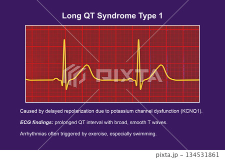 ECG in long QT syndrome type 1, 3D illustration, annotated ECG in long QT syndrome type 1, 3D illustration, annotated 134531861