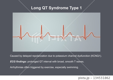 ECG in long QT syndrome type 1, 3D illustration, annotated 134531862