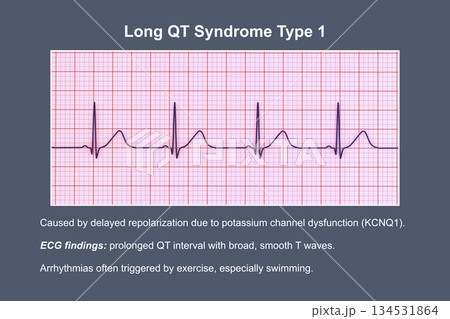 ECG in long QT syndrome type 1, 3D illustration, annotated ECG in long QT syndrome type 1, 3D illustration, annotated 134531864