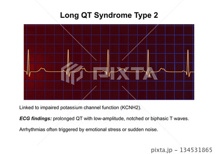 ECG in long QT syndrome type 2, 3D illustration, annotated 134531865