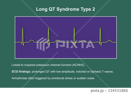 ECG in long QT syndrome type 2, 3D illustration, annotated ECG in long QT syndrome type 2, 3D illustration, annotated 134531868