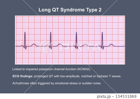 ECG in long QT syndrome type 2, 3D illustration, annotated 134531869