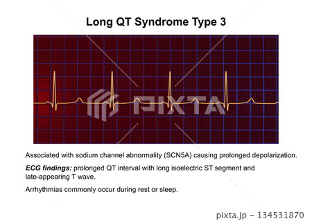 ECG in long QT syndrome type 3, 3D illustration, annotated ECG in long QT syndrome type 3, 3D illustration, annotated 134531870